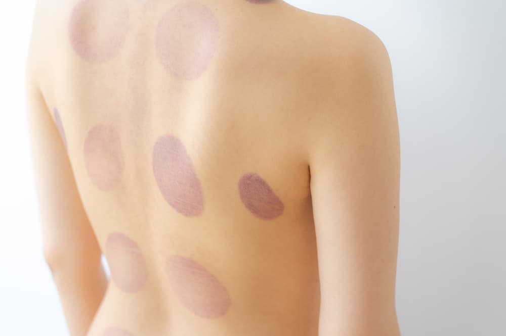 出血・皮下出血について